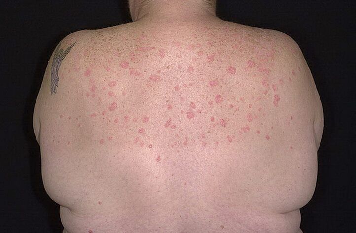 Psoriasis en los hombros