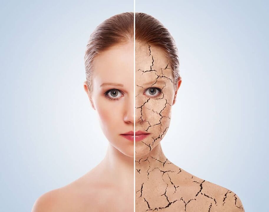 Piel sana y piel afectada por psoriasis