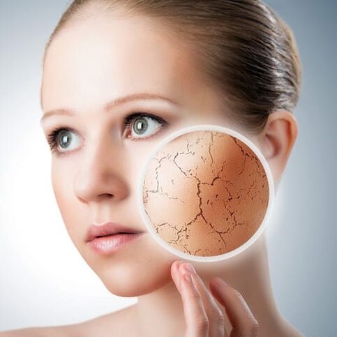 Psoriasis en la cara