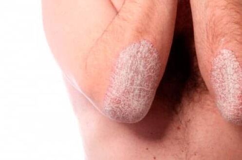 Psoriasis en los codos
