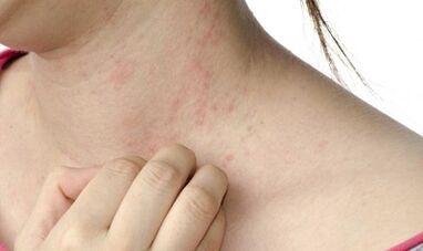 Tratamiento de la psoriasis en estadio avanzado.