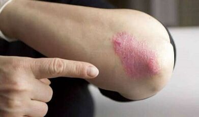 etapa estacionaria del desarrollo de la psoriasis