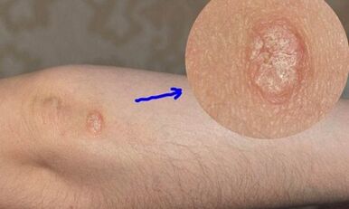 etapas del desarrollo de la psoriasis