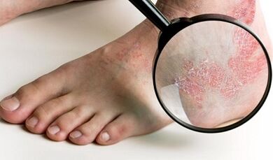 opciones de tratamiento de la psoriasis