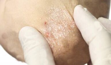 tratamiento de la psoriasis en la etapa de atenuación