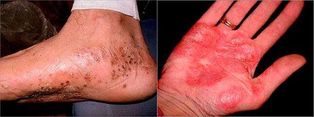 Psoriasis palmoplantar