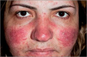 Psoriasis seborreica