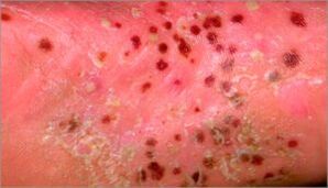 psoriasis pustulosa