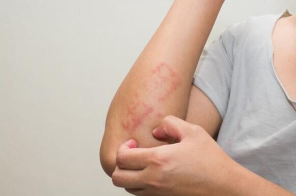 Los últimos métodos para tratar la psoriasis