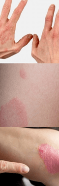 Psoriasis de la etapa inicial en las manos