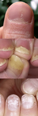 Psoriasis de uñas - etapa inicial