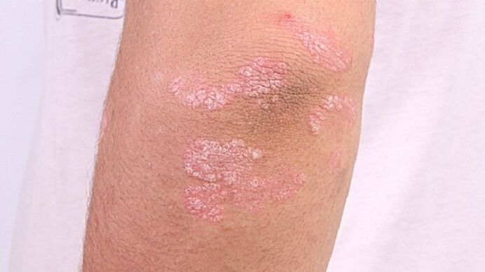foto de psoriasis en etapa temprana