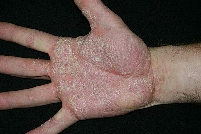 psoriasis de las palmas y los pies