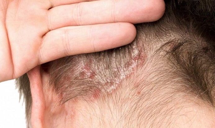 psoriasis en la cabeza