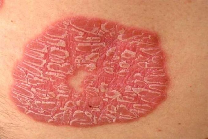 psoriasis pustulosa