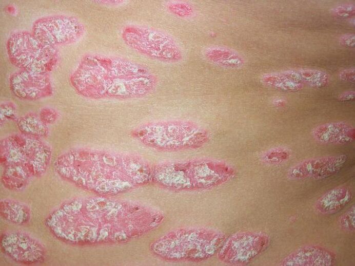 soriasis en placas
