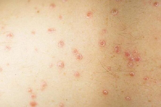 síntomas de la psoriasis localizada