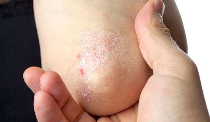 síntomas de psoriasis en la etapa inicial