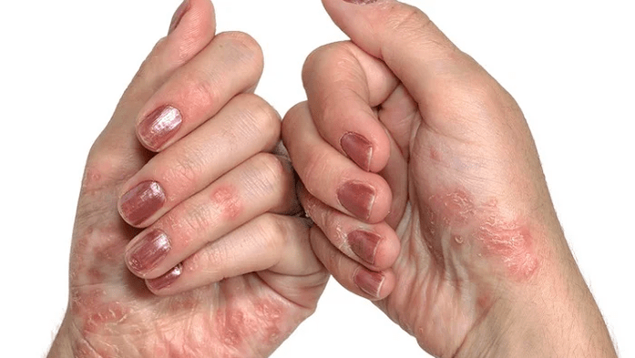etapa inicial de la psoriasis