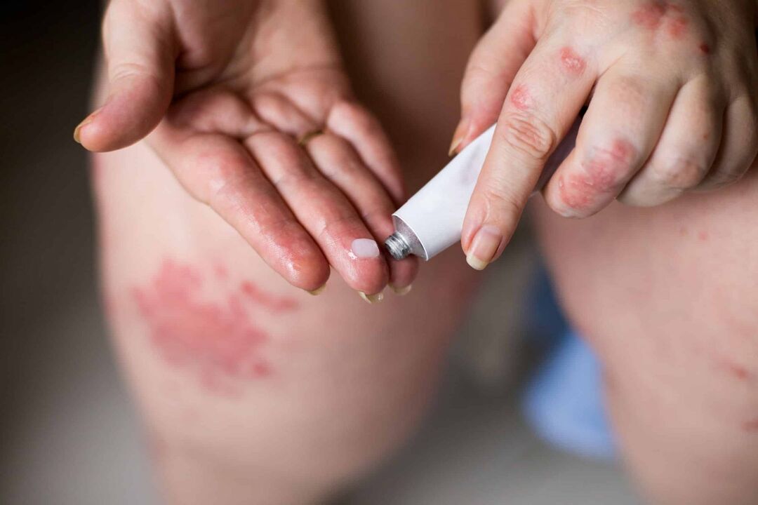 Tratamiento de la psoriasis