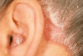 causas de la psoriasis