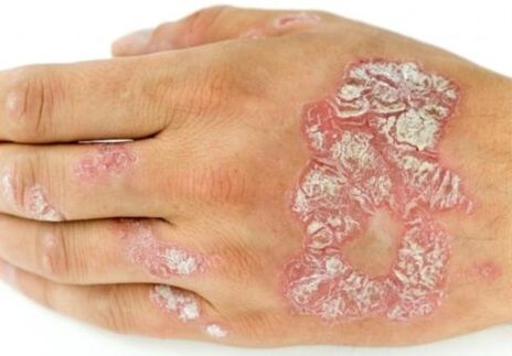 psoriasis en la mano