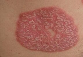 fotos de psoriasis en la piel