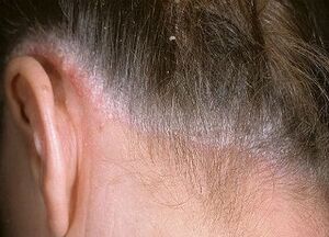 causas de psoriasis en la cabeza