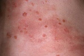 foto de psoriasis en la piel