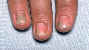 causas de la psoriasis en las uñas